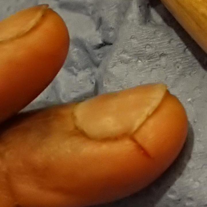 Finger injury due to metalsmithng